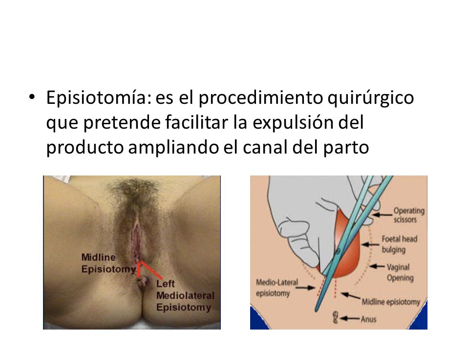 fotos de episiotomia reales